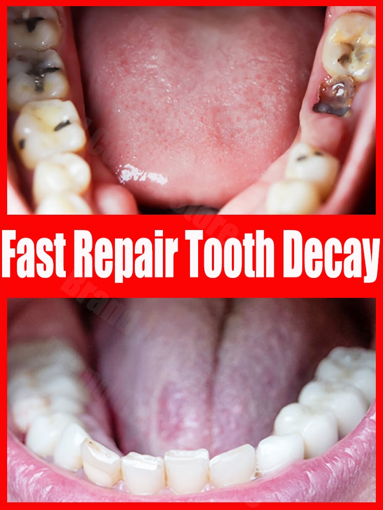 Tooth decay repair Repair all tooth decay, cavities and protect teeth
